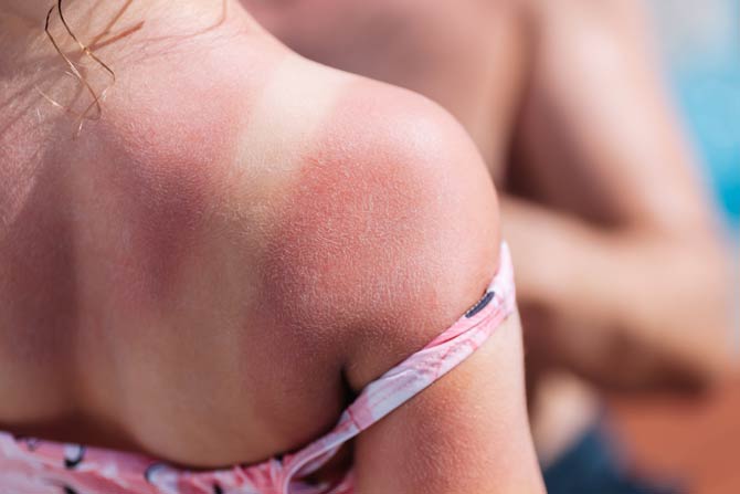 Bräunungsstreifen sogenannte Tan-Lines beim Tanmaxxing