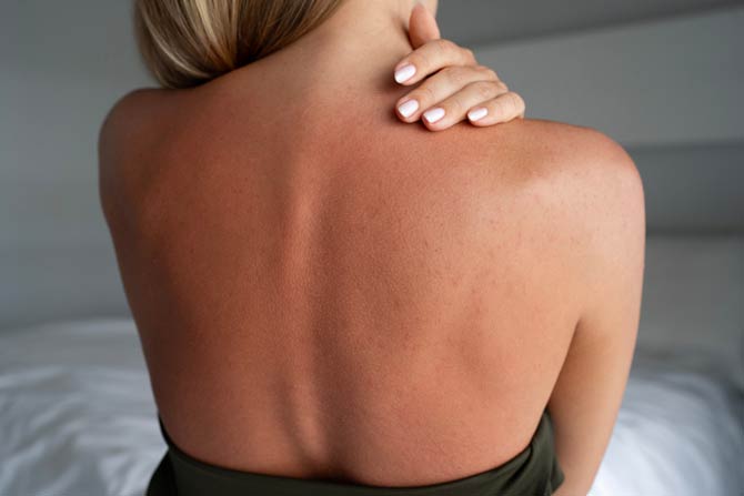 Intensivere UV-Strahlung führt zu steigenden Zahlen bei Hautkrebs Erkrankungen