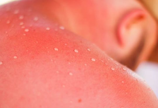 Sonnenbrand
