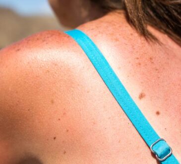 Tanmaxxing – der gefährliche Trend zum Sonnenbrand