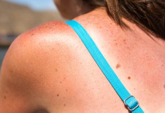 Tanmaxxing – der gefährliche Trend zum Sonnenbrand