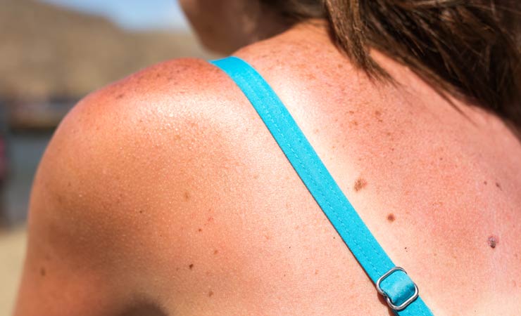 Tanmaxxing – der gefährliche Trend zum Sonnenbrand